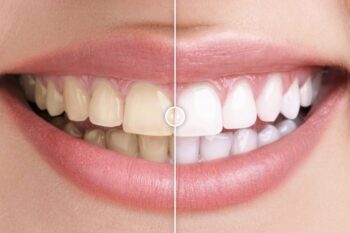 Before & After Görsel Karşılaştırma WordPress Eklentisi
